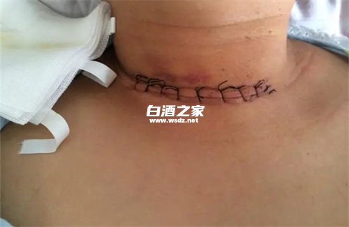 甲状腺手术后可以少喝点白酒吗