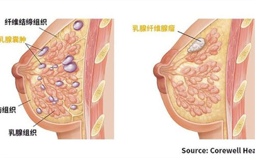 喝白酒可以祛除乳腺结节吗  2